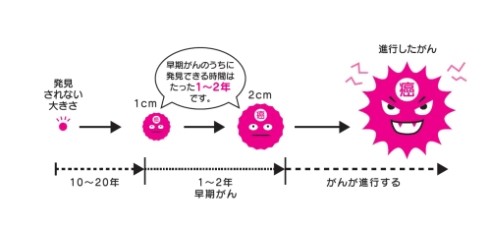 がんの進行画像