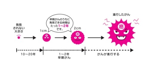 がんの進行画像