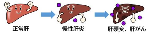 正常肝　慢性肝炎　肝硬変、肝がんのイラスト