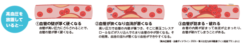 「高血圧を放置していると」血管の状態のイラスト