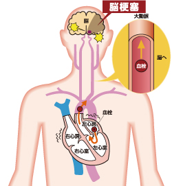脳卒中のイメージイラスト