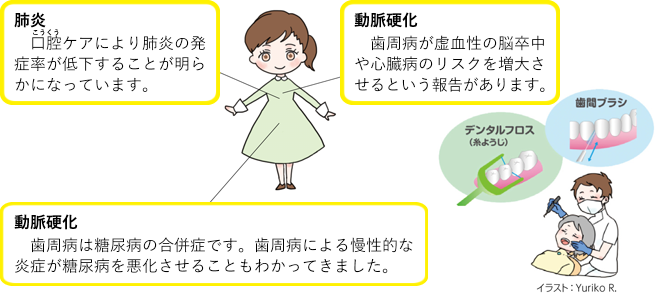 動脈硬化
　歯周病が虚血性の脳卒中や心臓病のリスクを増大させるという報告があります。
肺炎
　口腔（こうくう）ケアにより肺炎の発症率が低下することが明らかになっています。
糖尿病
　歯周病は糖尿病の合併症です。歯周病による慢性的な炎症が糖尿病を悪化させることもわかってきました。
歯間ブラシ
デンタルフロス（糸ようじ）
イラスト：Yuriko R.