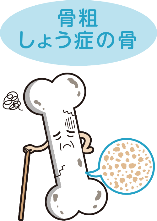 骨粗しょう症の骨